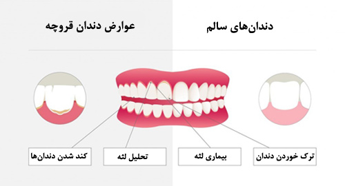 دندان-قروچه